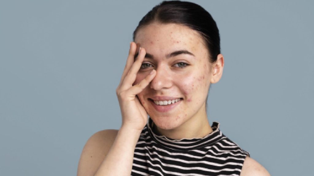 A smiling woman with acne